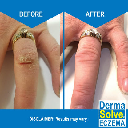 Dermasolve Eczema Relief Body Wash (2 Pack) | Protects, Moisturizes, and Repairs Skin - Kids